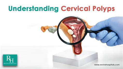 Dangerous Is A Cervical Polyp Role Of Ultrasound In Managing Cervical