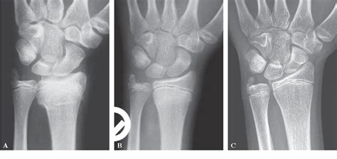 Figure 2 From Fracture Of The Ulnar Styloid Process Negatively Influences The Outcome Of Paediatric Fractures Of The Distal Radius Semantic Scholar