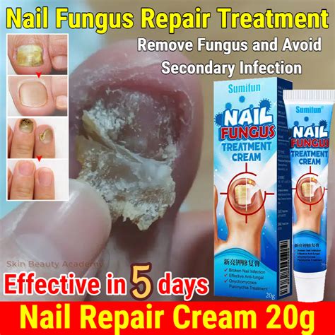 Fungal Nail Infection Treatment Best At Gary Delariva Blog