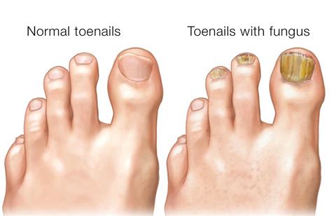 Fungal Nail Treatment With Medical Lasers At Radiant Living
