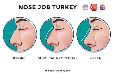How To Get Rid Of A Blocked Nose Op Dr Ruhi Istanbul Turkey
