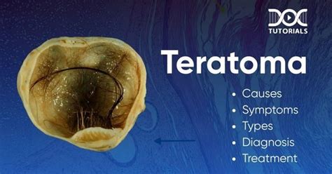 I Was Searching For Pictures Of Teratomas Tumours That Grow Teeth Hair And Other Organs And Now I M Concerned For Google S Ai