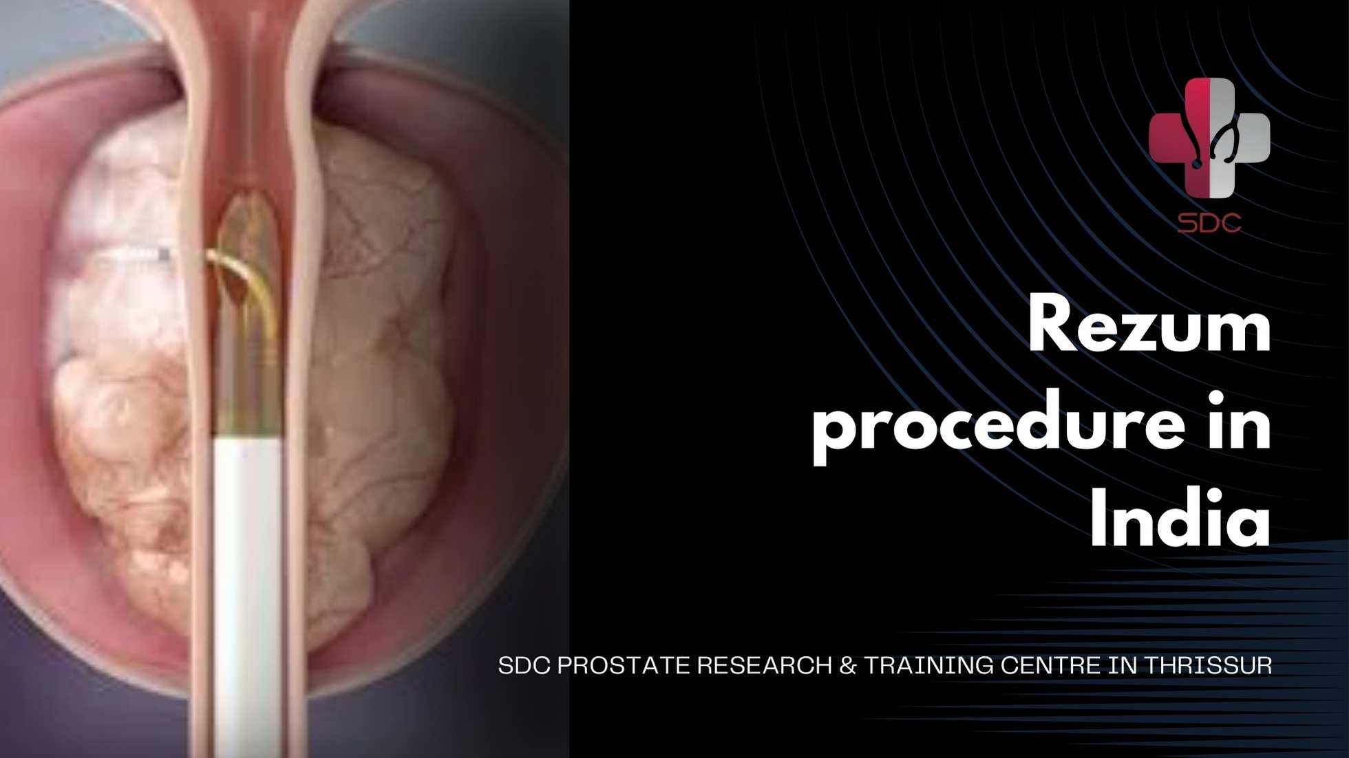 Prostate Enlargement Can Occur In Some Men After Age 40 Along With Medical Help Performing Specific Exercises To Strengthen Your Pelvis Can Be Beneficial And Kegel Exercises Are The Most Effective Among Prostate Enlargement Can Occur In Some Men After Age 40 Along With Medical Help Performing Specific Exercises To Strengthen Your Pelvis Can Be Beneficial And Kegel Exercises Are The Most Effective Among