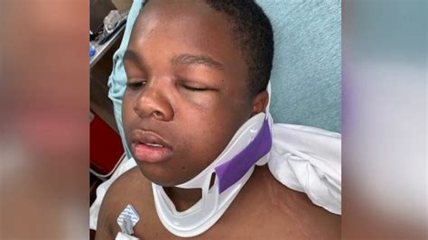 Scotland County Woman Talks About School Fight That Left Her Son Badly Hurt