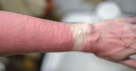 Skin Musculoskeletal Health Essential For Truck Drivers Tt