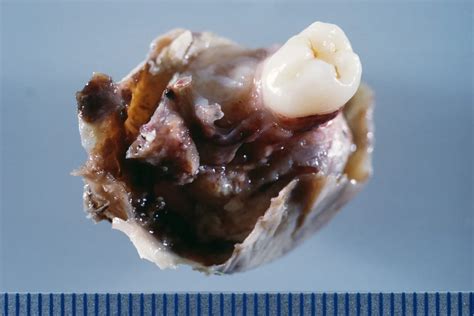 Tumors Can Grow Teeth Discovery