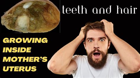 Ultrasound Reveals Teeth And Hair Growing Inside Mother S Uterus The Independent