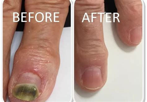 What Is The Most Effective Fungal Nail Treatment Sussex Foot Centre