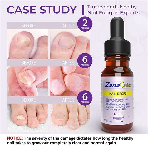 Zanaquick Toenail Fungus Treatment Drops 2 Pack Powerful Nail